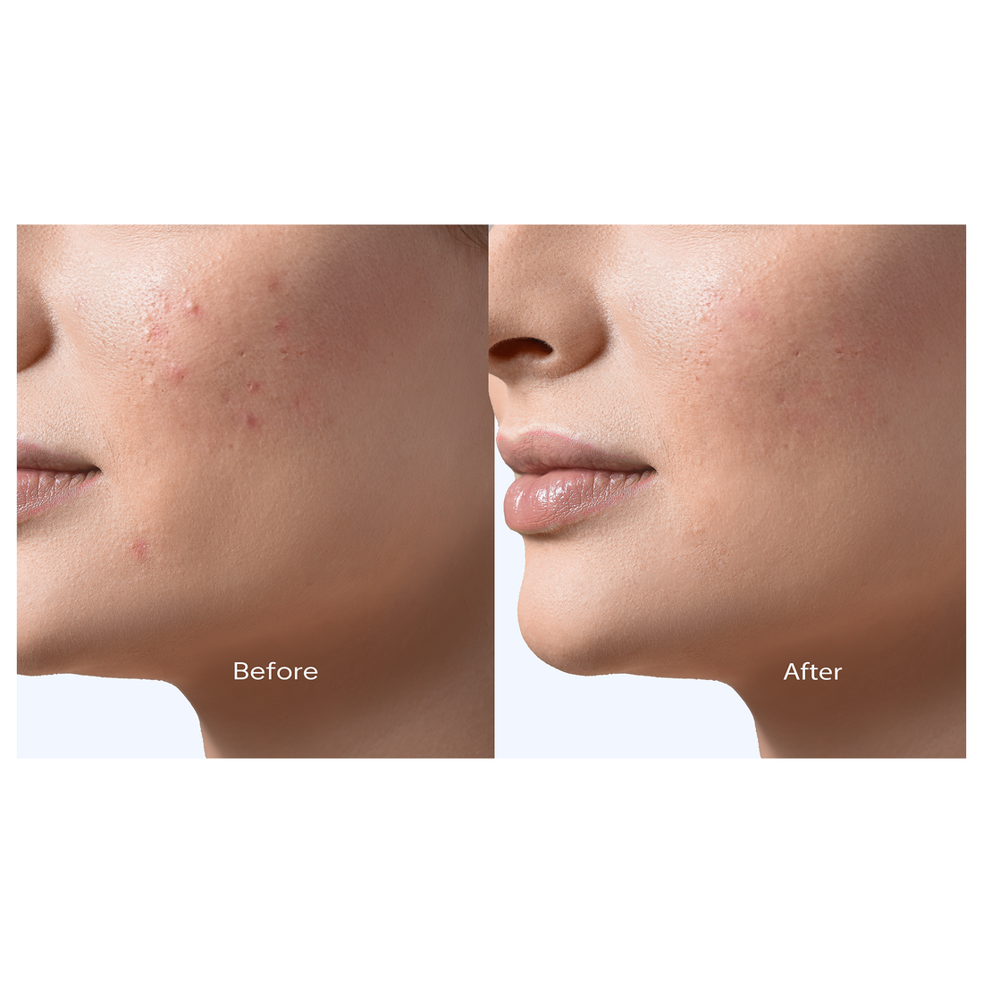 Reiyne Zap It! Blemish Spot Treatment in white airless point with purple and white label 