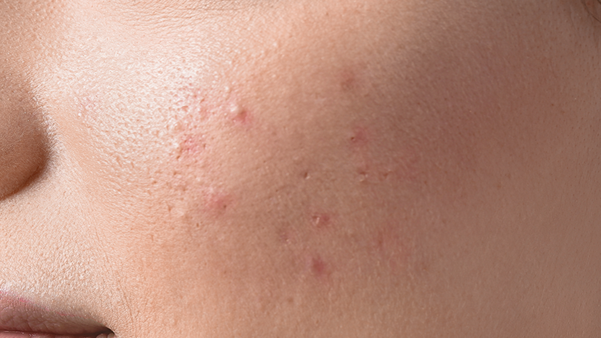 Reiyne Zap It! Blemish Spot Treatment in white airless point with purple and white label 